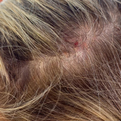 Scalp drynessandinflammation